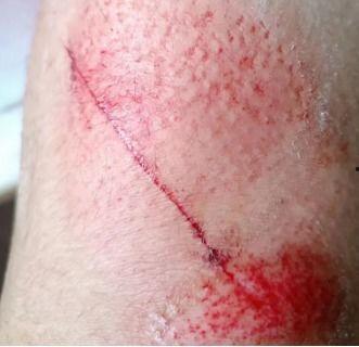 摔伤图片,惊心动魄的瞬间回顾